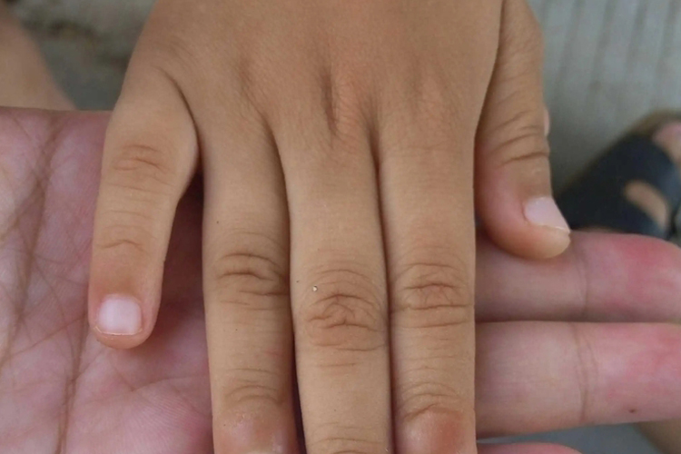 儿童缺锌缺铁手指甲发白图