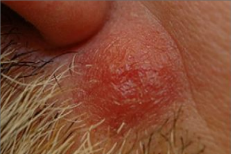 男性结节性梅毒疹大红疙瘩图 男性结节性梅毒疹大红疙瘩图