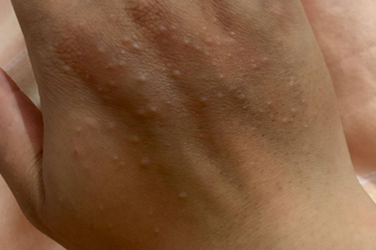 肢端持久型丘疹黏蛋白症症状图