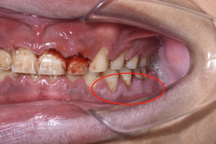 急性坏死性龈口炎白斑图