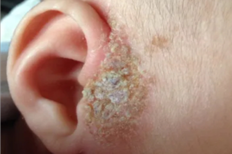 奶癣耳周黄痂图