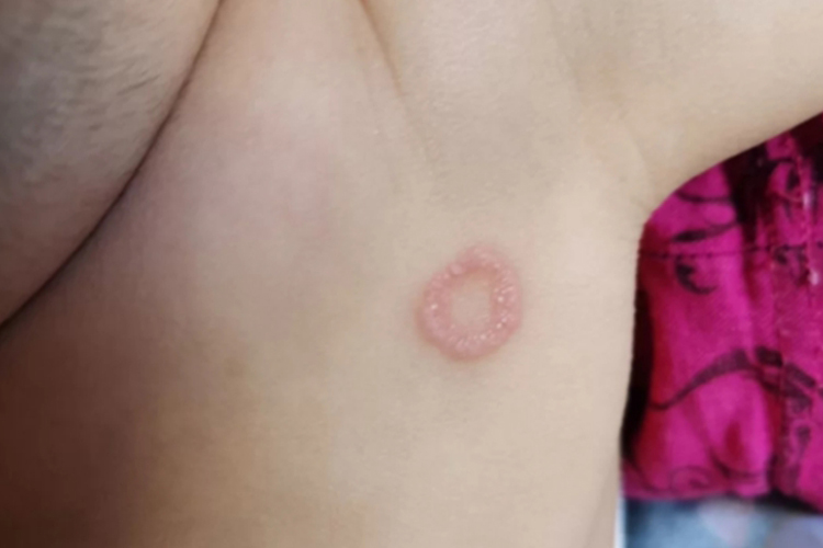 婴儿钱币状湿疹图 婴儿钱币状湿疹图