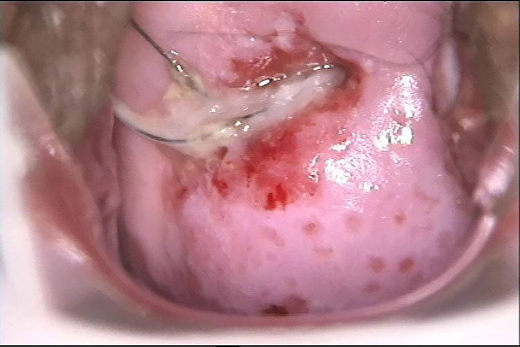 滴虫性阴道炎图