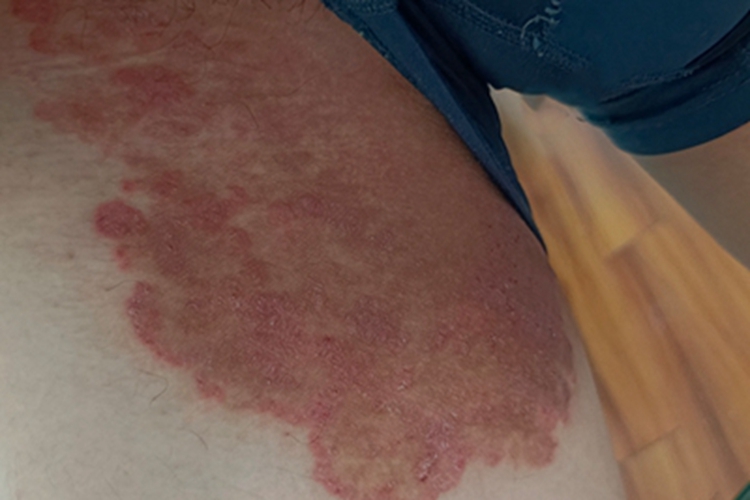 慢性湿疹大腿症状图 慢性湿疹大腿症状图