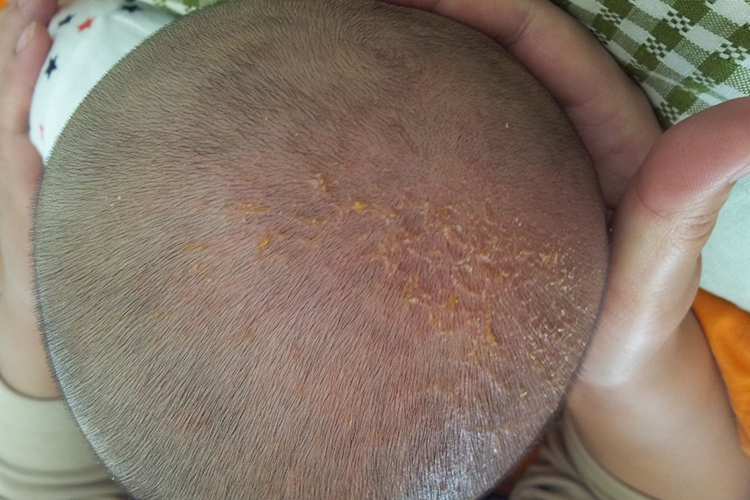 婴儿湿疹引起黄痂图