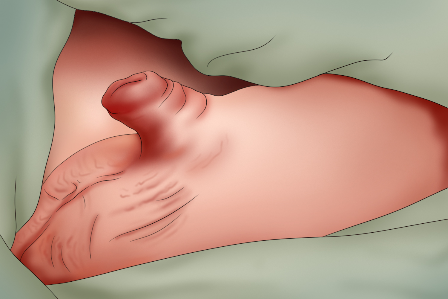 隐匿阴茎阴茎发育不良图 隐匿阴茎阴茎发育不良图