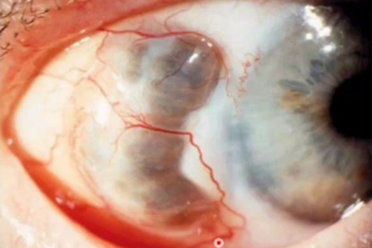 巩膜葡萄肿眼球疙瘩图 巩膜葡萄肿眼球疙瘩图