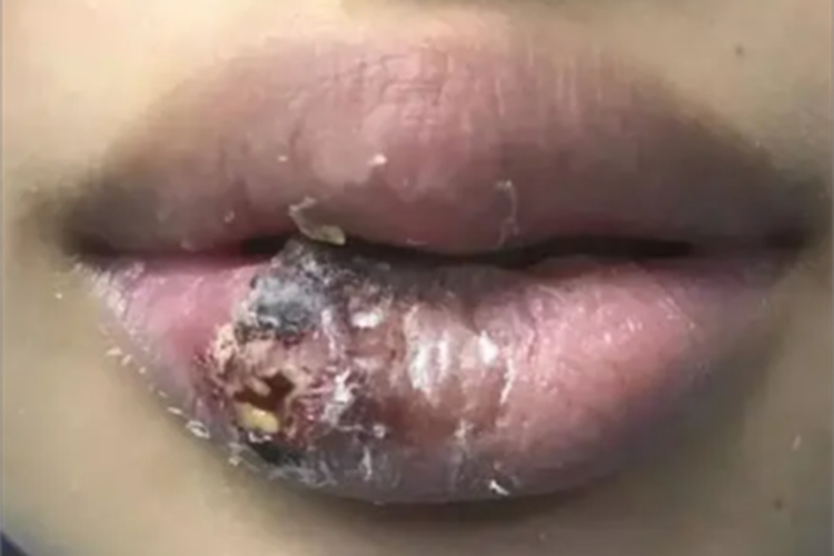 皮肤利什曼病嘴唇结痂图