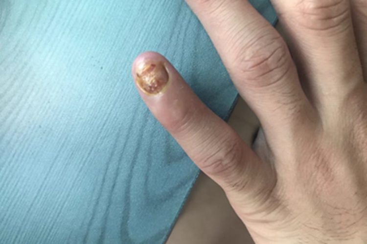 全甲损毁型甲真菌病手指甲萎缩图 全甲损毁型甲真菌病手指甲萎缩图