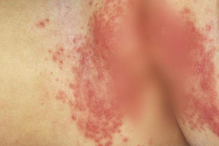 尿不湿过敏丘疹症状图 尿不湿过敏丘疹症状图