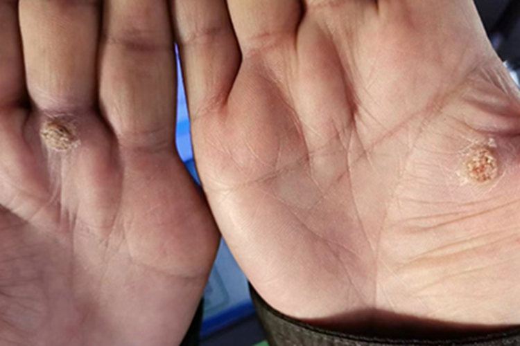 寻常疣手掌粗糙图 寻常疣手掌粗糙图