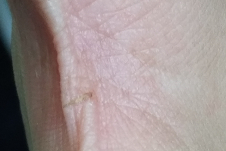 刺伤手部虎口红肿图