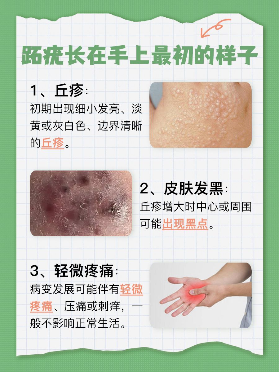 揭秘:跖疣长在手上最初的样子