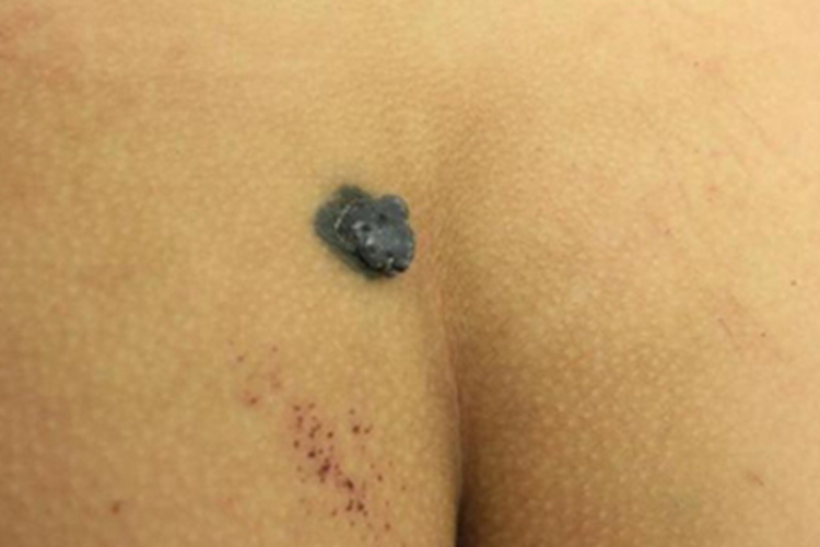 细胞蓝痣臀部症状图