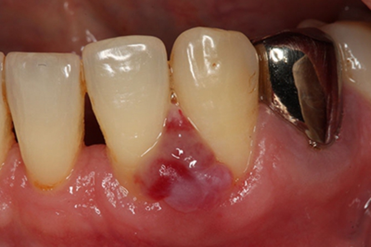 牙龈瘤牙龈症状图