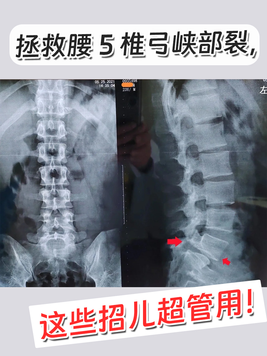拯救腰5椎弓峡部裂，这些招儿超管用！