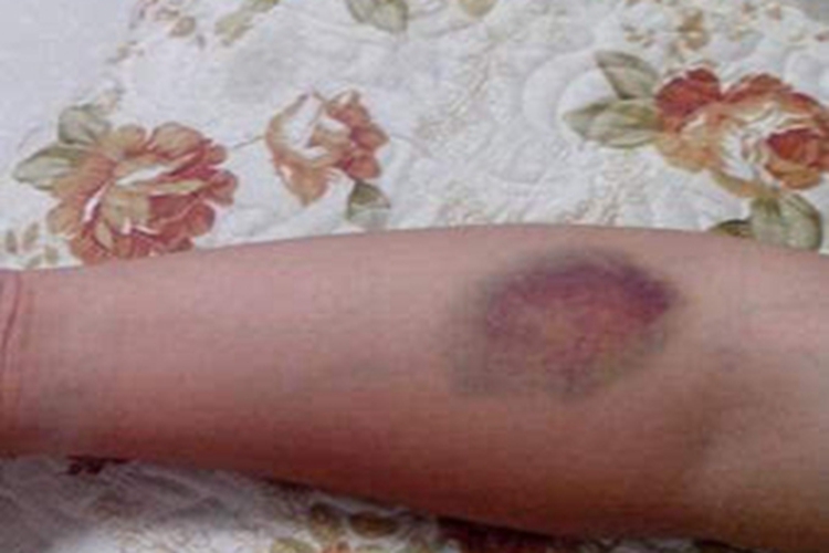 血友病A症状图 血友病A症状图