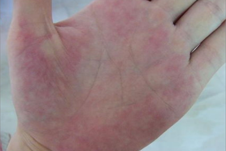 妊娠期掌红斑手掌红斑图