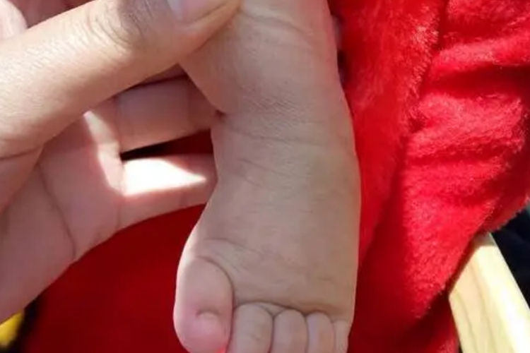 新生儿轻微足内翻图