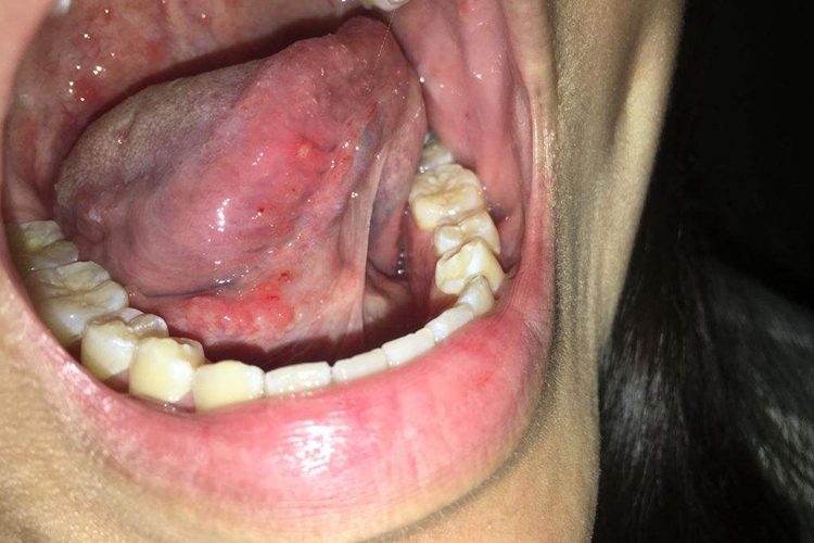 口腔单纯疱疹图