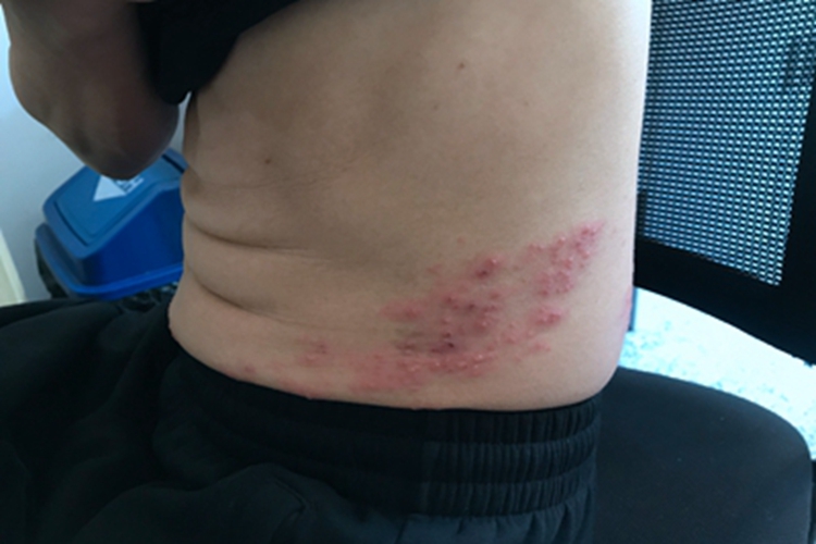 带状疱疹腰部有好多水疱图