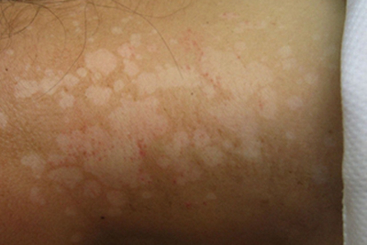 特发性点状色素减退斑颈部症状图