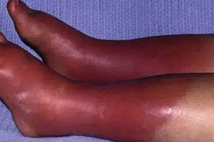 红斑性肢痛症小腿症状图 红斑性肢痛症小腿症状图