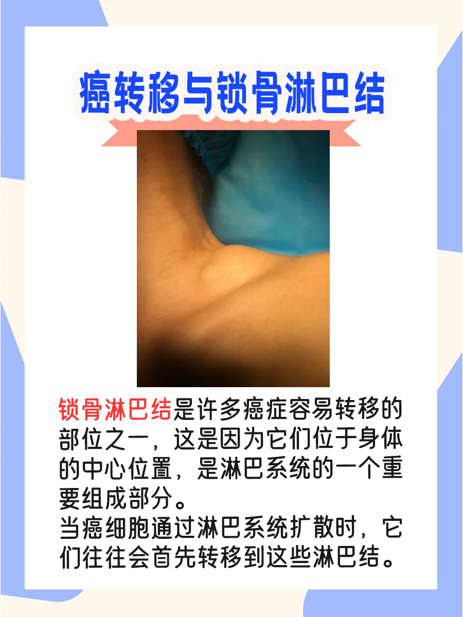 癌友需知：锁骨淋巴结超过1cm，小心癌转移！
