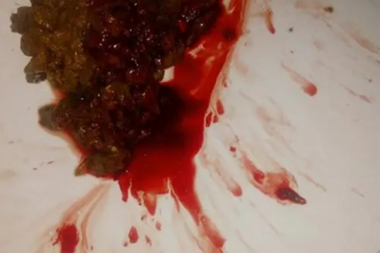 急性出血性肠炎大便图