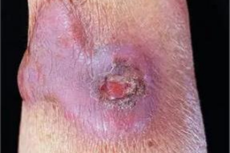 皮肤非典型分枝杆菌病胳膊溃疡图 皮肤非典型分枝杆菌病胳膊溃疡图