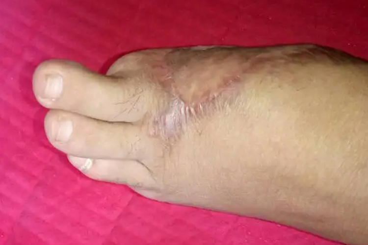 脚趾缺失截趾手术图