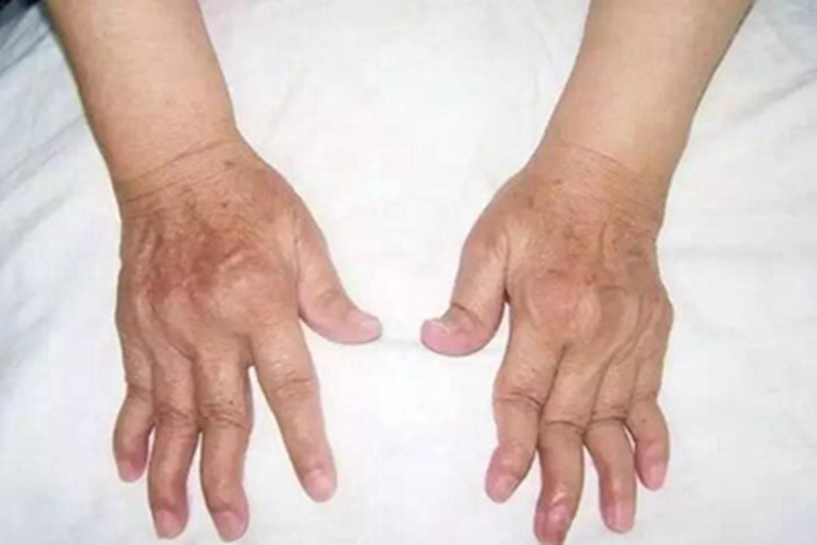 费尔蒂综合征手指畸形图