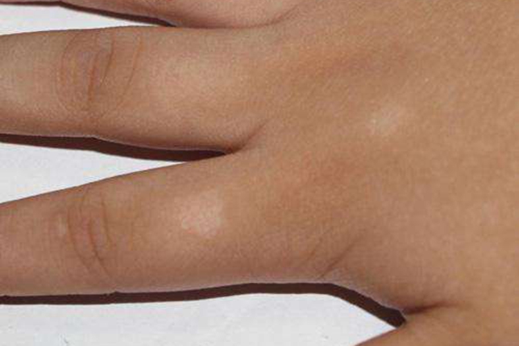 手部贫血痣白斑图