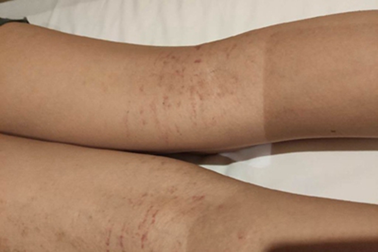 血管内压力增多性紫癜红点图