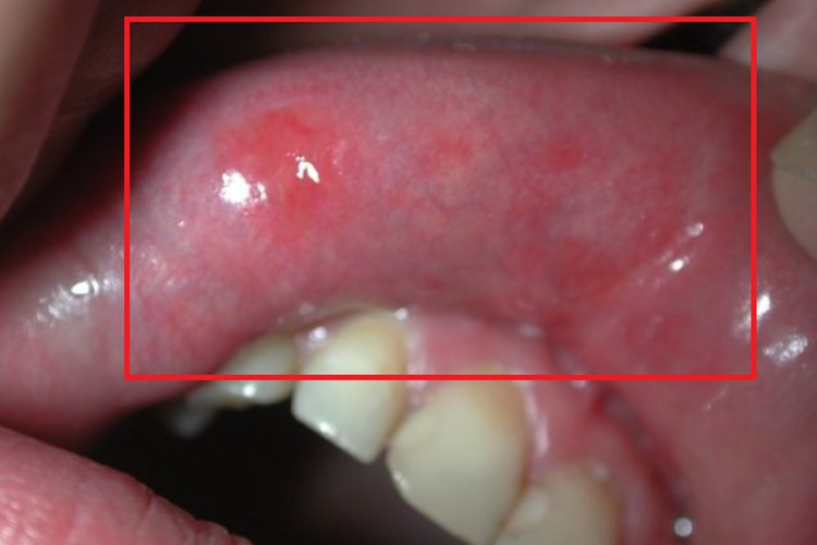 颌面部获得性梅毒唇内侧红斑图