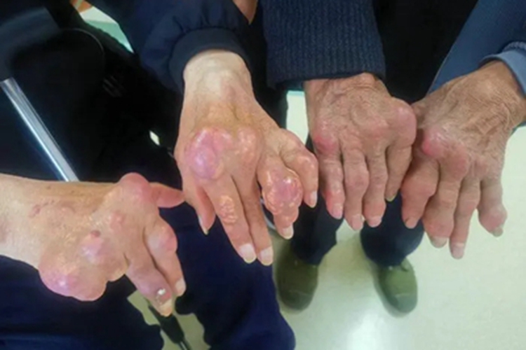 痛风性关节炎手部症状图