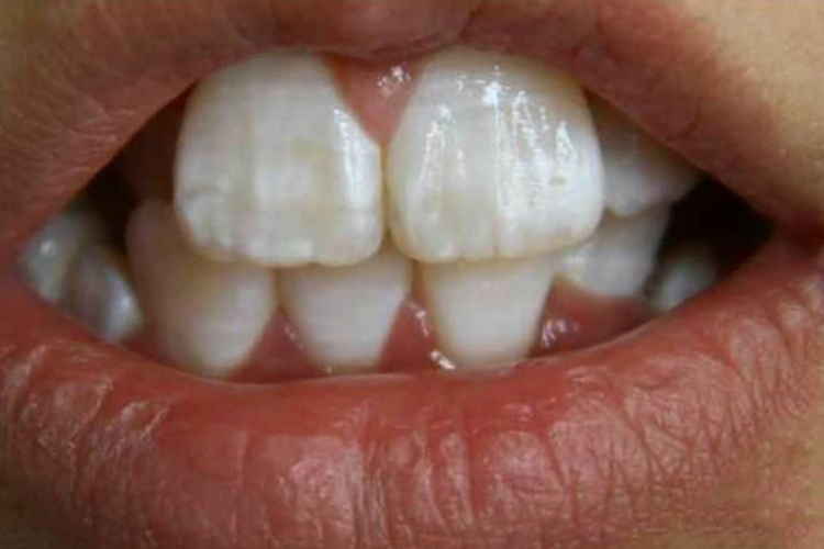 牙釉质矿化不全图