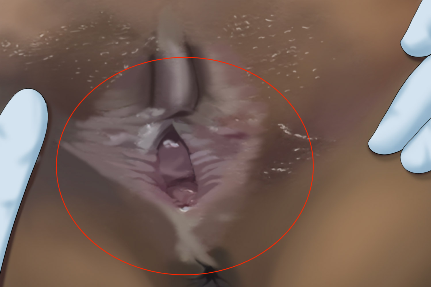 老年性外阴萎缩小阴唇皮肤萎缩图