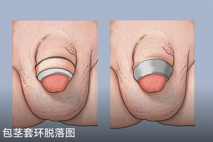 儿童环套手术环脱落图