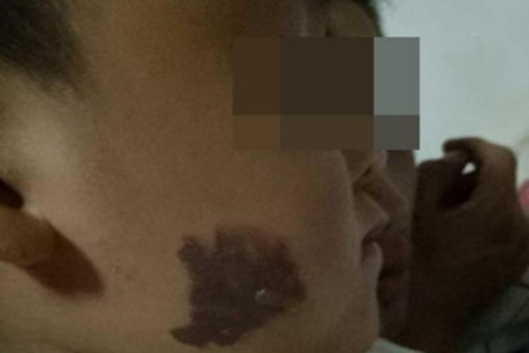 咖啡斑面部右侧深棕色斑块图