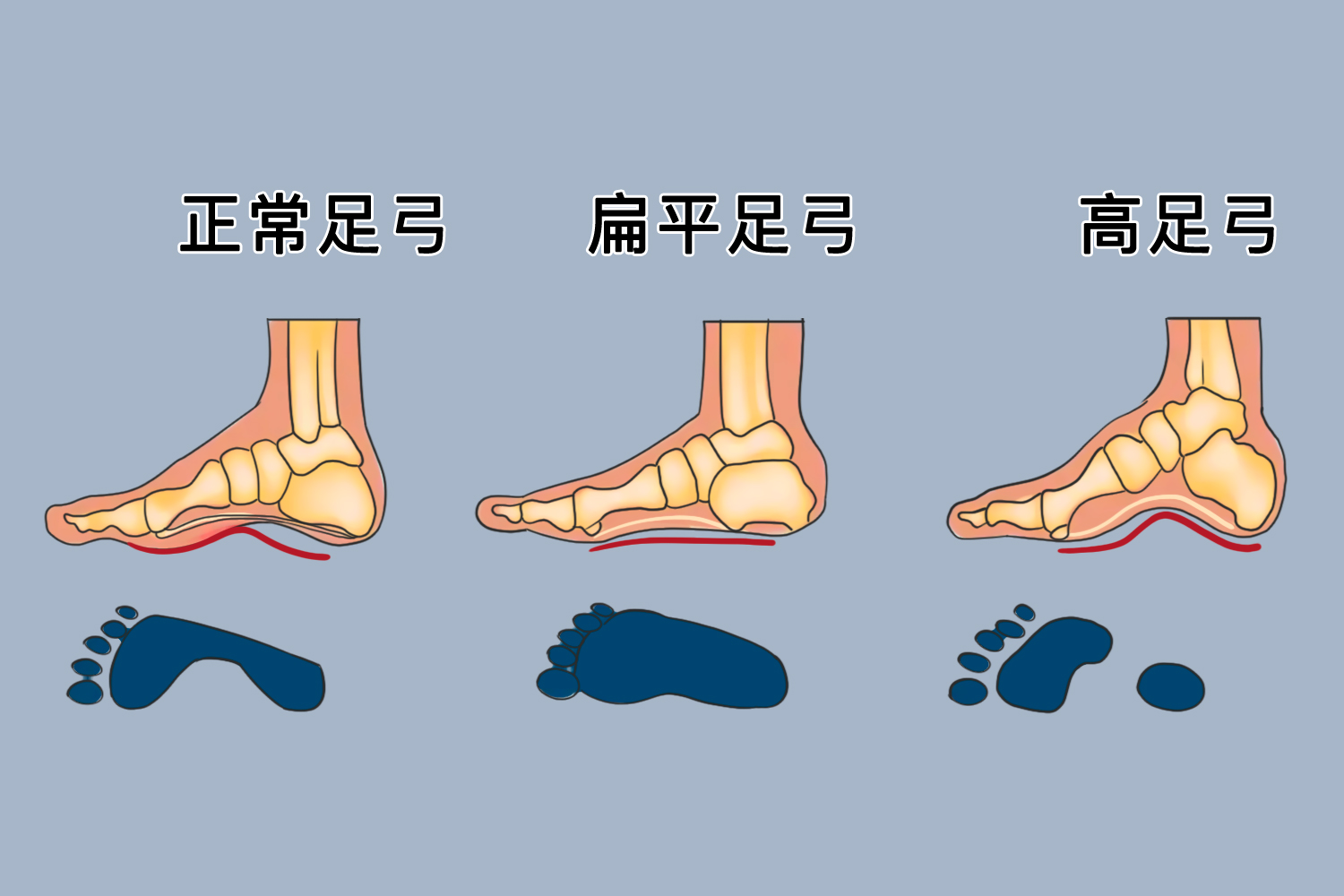 足弓高低判断图