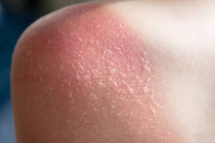 日照性皮炎水疱图