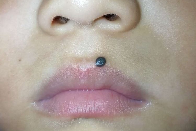 儿童嘴唇上长黑点图片