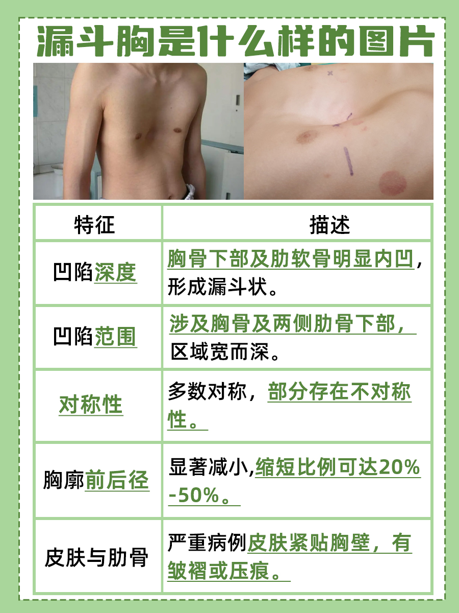 带你揭秘！漏斗胸是什么样子的图？