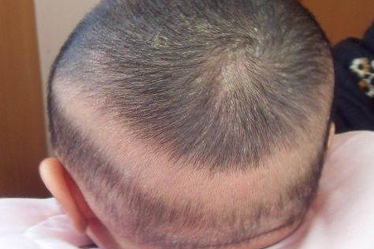 两个月宝宝枕秃图 两个月宝宝枕秃图