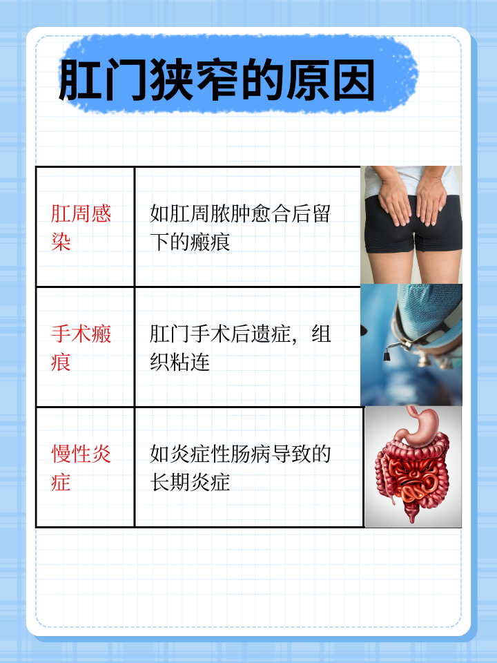 肛门狭窄界定：大便粗细的正常范围与注意事项