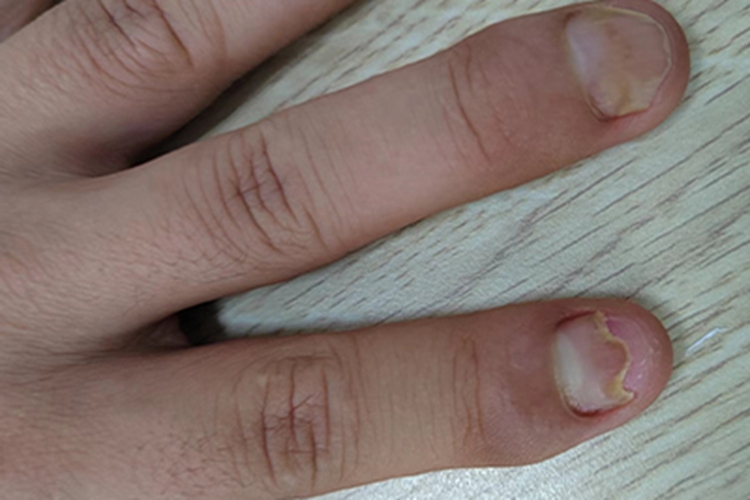 关节病型银屑病手指甲症状图