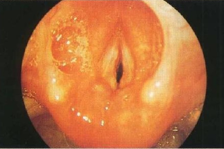 急性喉炎咽喉水疱图