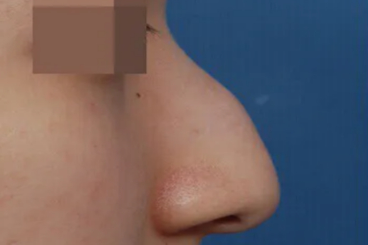 驼峰鼻鼻尖呈勾状下垂图 驼峰鼻鼻尖呈勾状下垂图