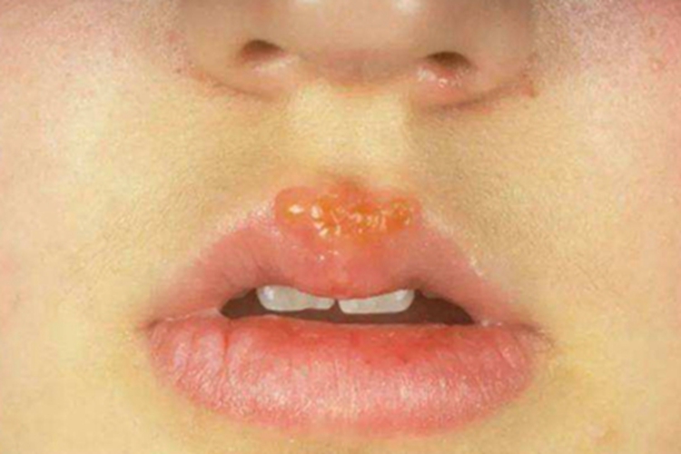 口唇疱疹嘴唇黄色水疱图